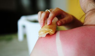 How to avoid sunburns during the summer