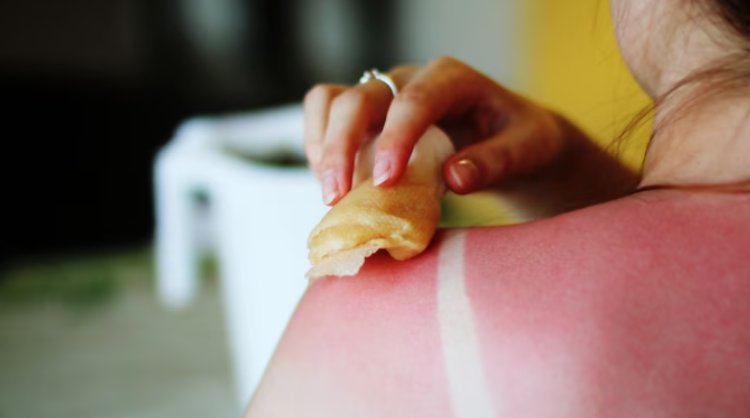 How to avoid sunburns during the summer